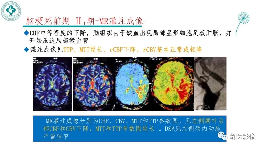 影像PPT - 【PPT】脑灌注成像原理及在临床中的应用-19