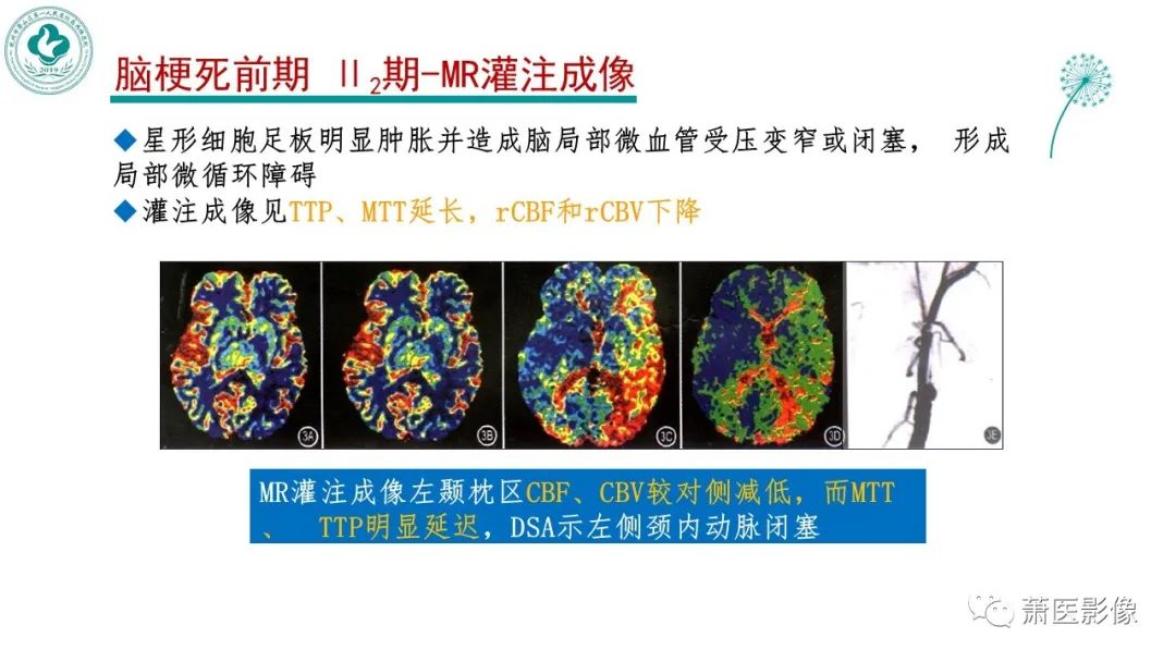 影像PPT - 【PPT】脑灌注成像原理及在临床中的应用-20
