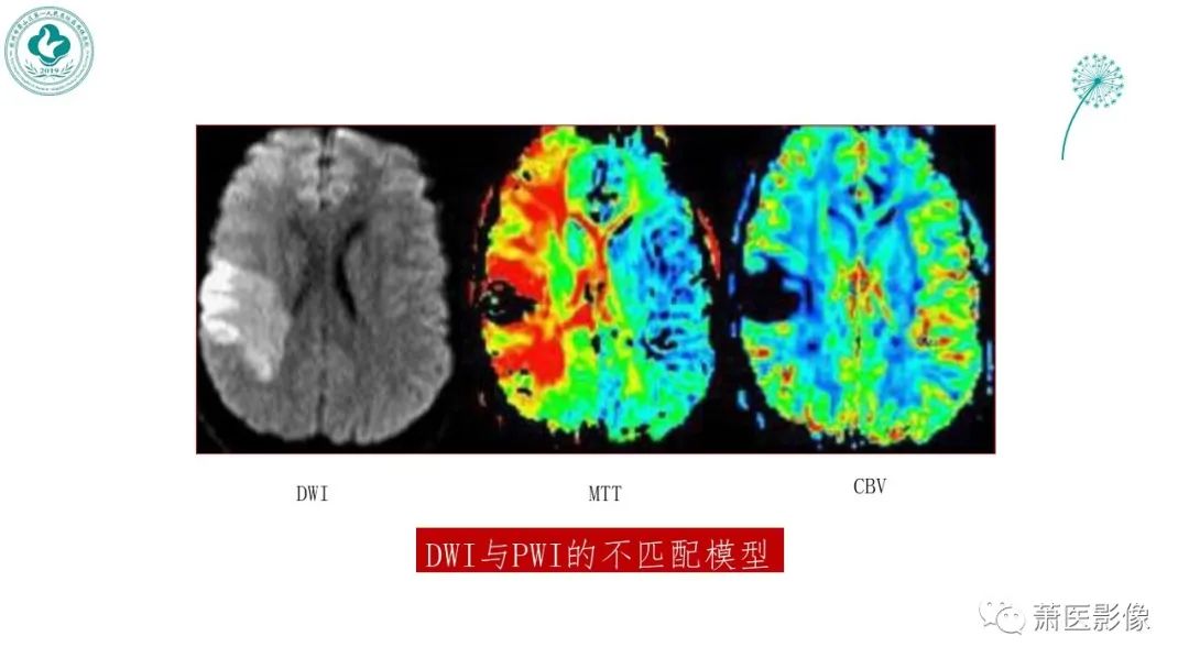 影像PPT - 【PPT】脑灌注成像原理及在临床中的应用-26