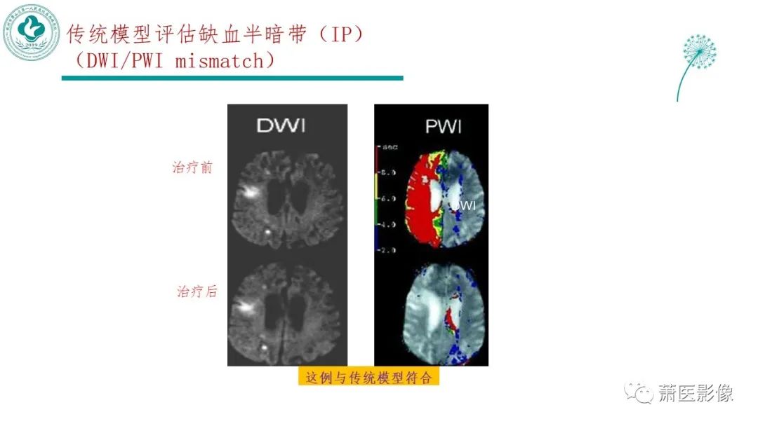 影像PPT - 【PPT】脑灌注成像原理及在临床中的应用-28