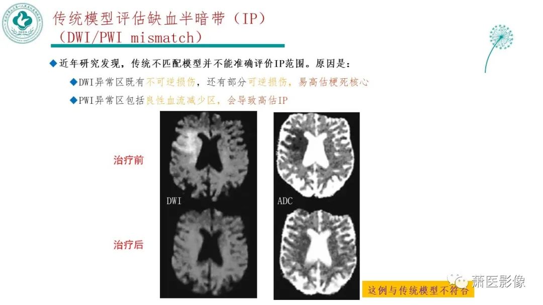 影像PPT - 【PPT】脑灌注成像原理及在临床中的应用-29