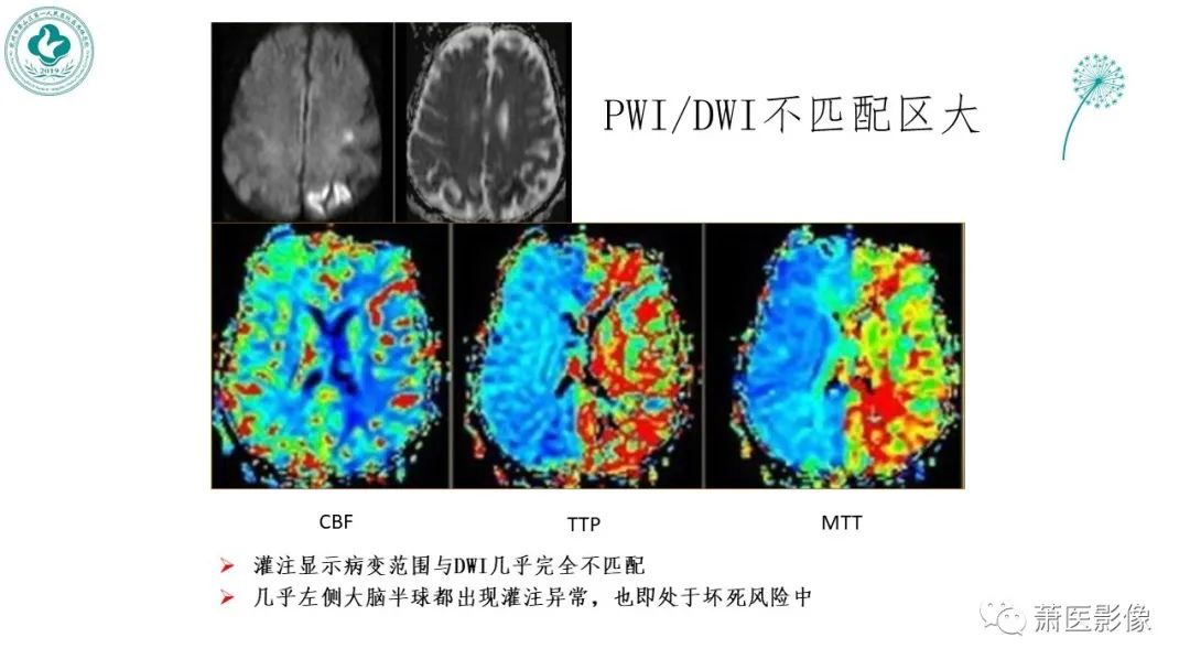 影像PPT - 【PPT】脑灌注成像原理及在临床中的应用-33