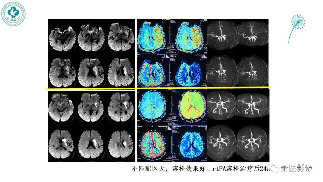 影像PPT - 【PPT】脑灌注成像原理及在临床中的应用-34