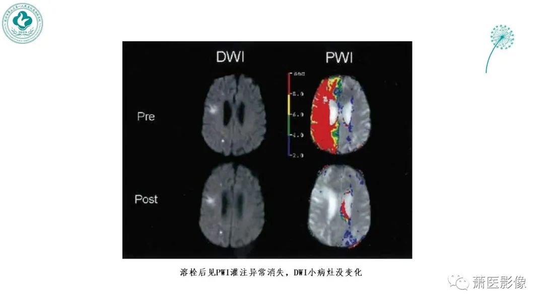 影像PPT - 【PPT】脑灌注成像原理及在临床中的应用-35
