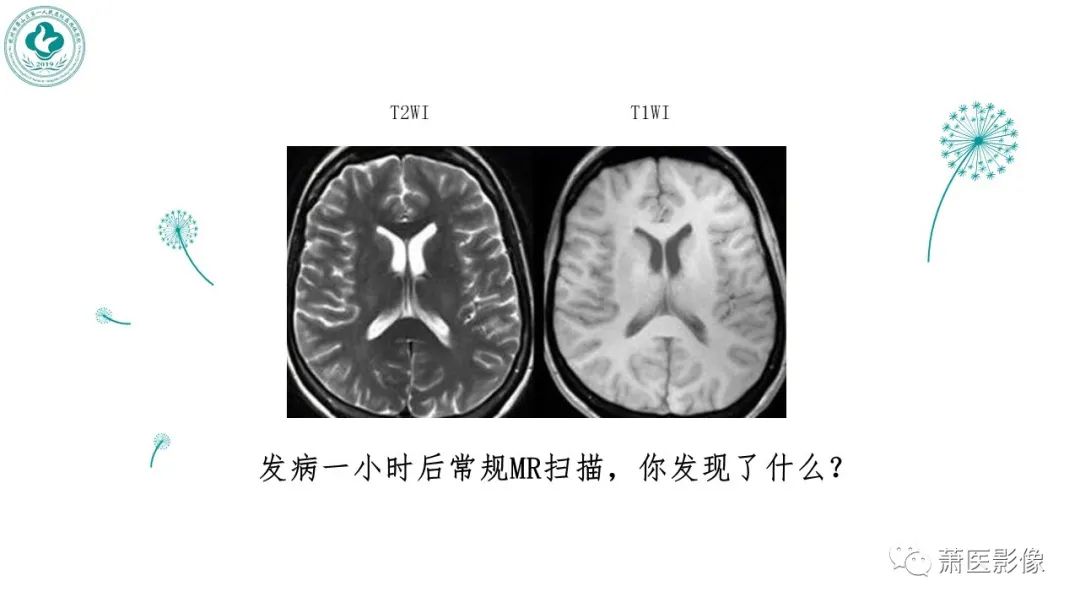 影像PPT - 【PPT】脑灌注成像原理及在临床中的应用-36