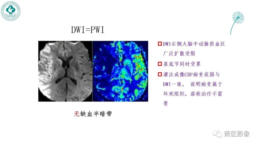 影像PPT - 【PPT】脑灌注成像原理及在临床中的应用-37