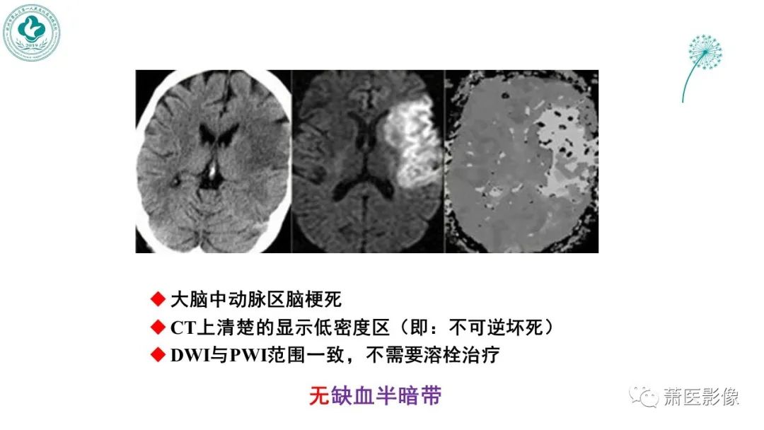 影像PPT - 【PPT】脑灌注成像原理及在临床中的应用-38