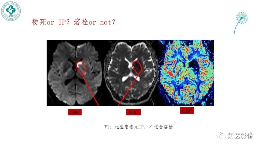 影像PPT - 【PPT】脑灌注成像原理及在临床中的应用-39