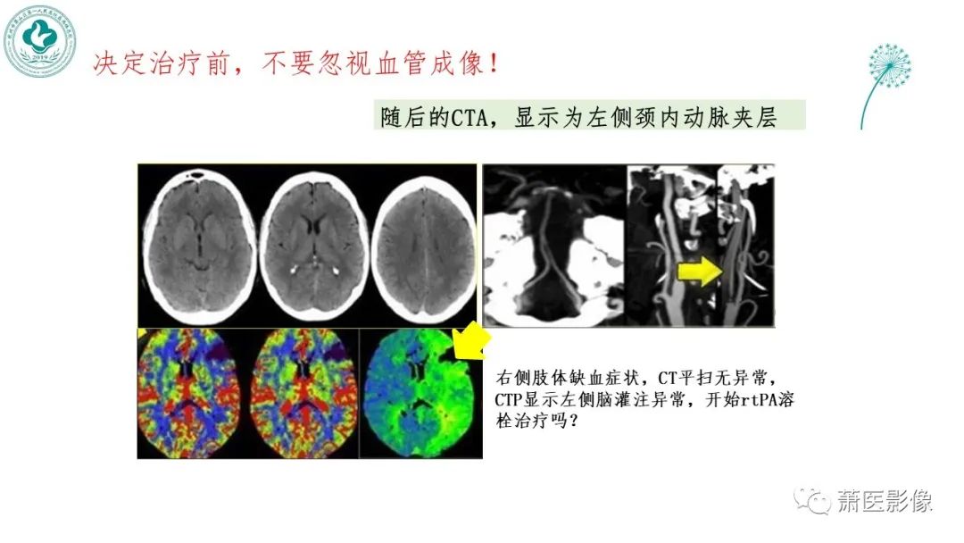 影像PPT - 【PPT】脑灌注成像原理及在临床中的应用-40