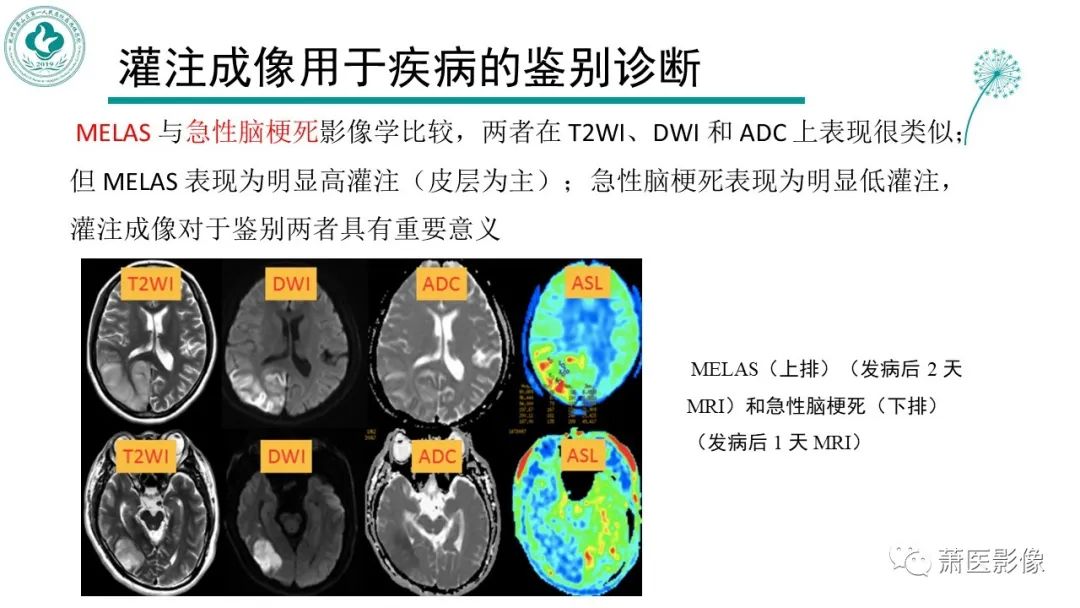 影像PPT - 【PPT】脑灌注成像原理及在临床中的应用-41