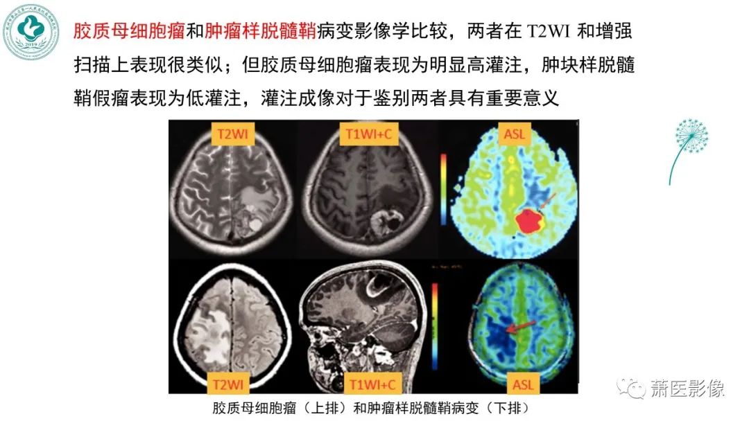 影像PPT - 【PPT】脑灌注成像原理及在临床中的应用-42