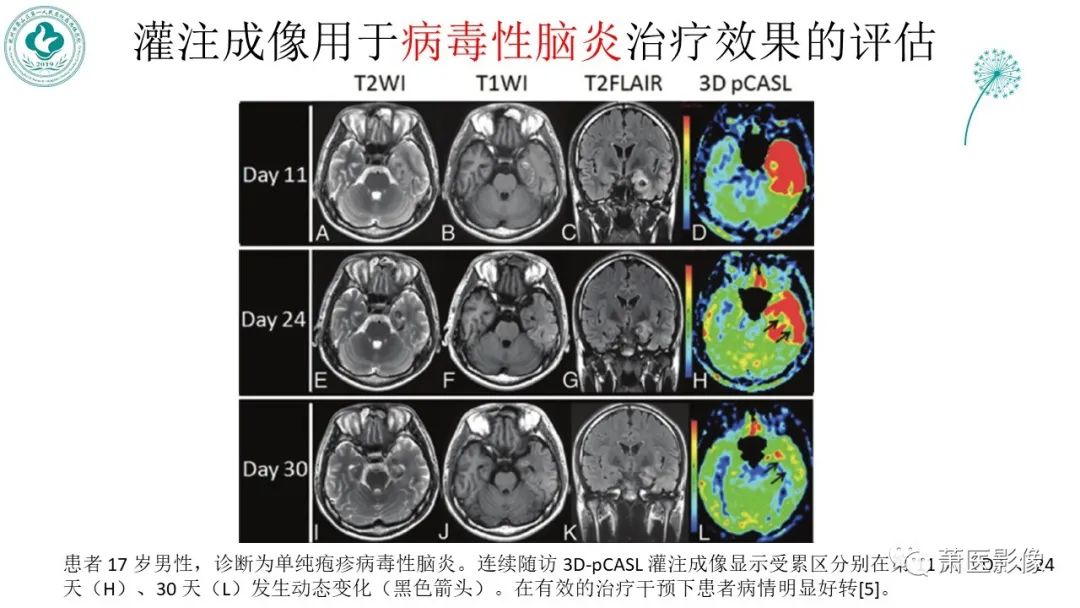 影像PPT - 【PPT】脑灌注成像原理及在临床中的应用-44
