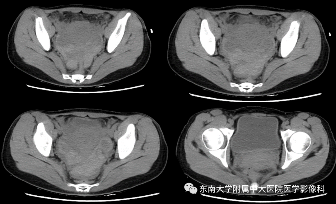 影像PPT - 【PPT】常见妇科急腹症的超声-放射诊断-2
