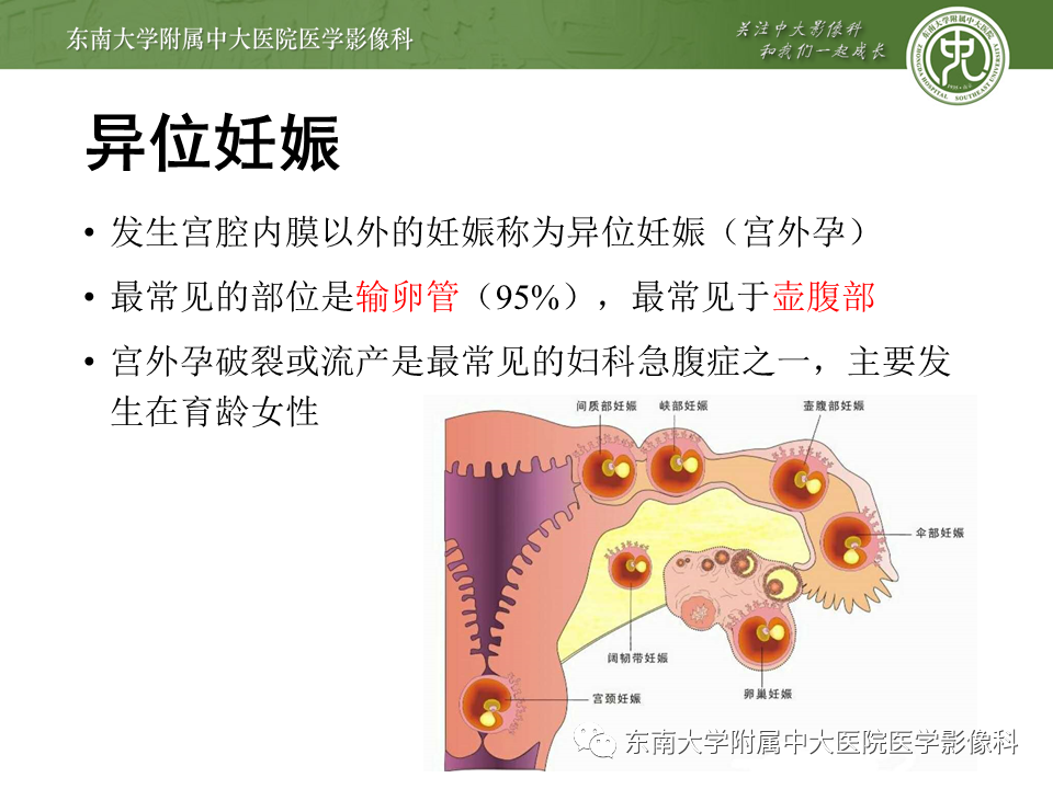 影像PPT - 【PPT】常见妇科急腹症的超声-放射诊断-9