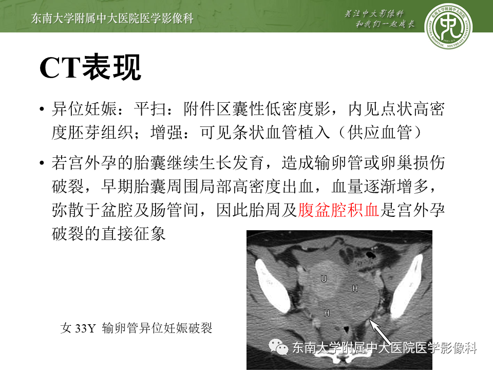 影像PPT - 【PPT】常见妇科急腹症的超声-放射诊断-13