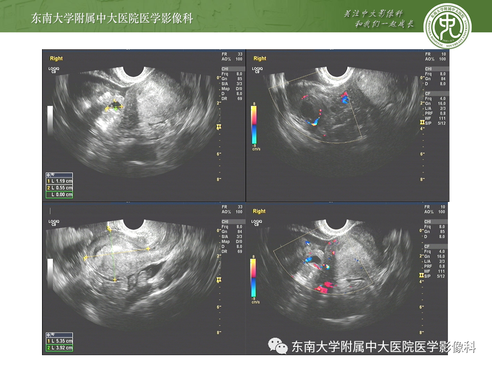 影像PPT - 【PPT】常见妇科急腹症的超声-放射诊断-12