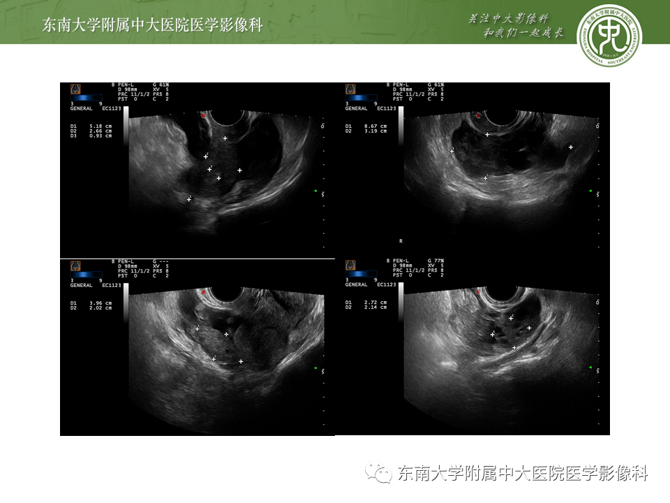影像PPT - 【PPT】常见妇科急腹症的超声-放射诊断-14