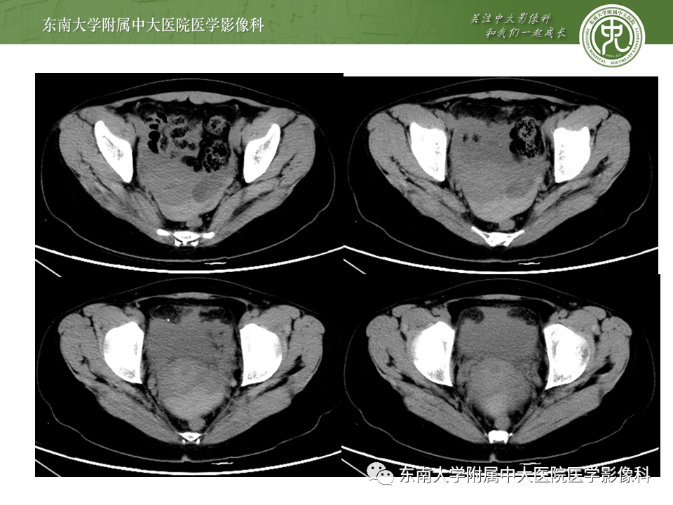 影像PPT - 【PPT】常见妇科急腹症的超声-放射诊断-15