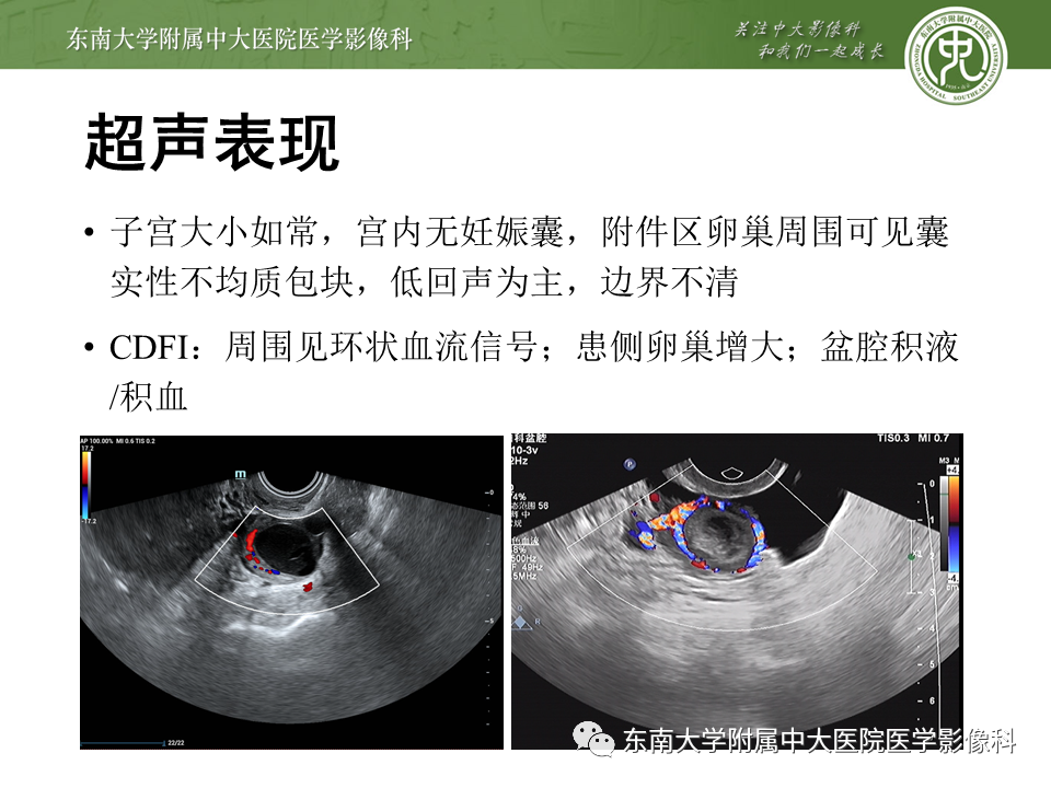 影像PPT - 【PPT】常见妇科急腹症的超声-放射诊断-18