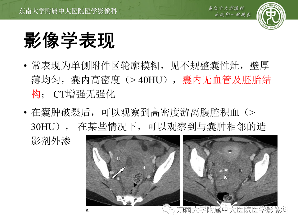 影像PPT - 【PPT】常见妇科急腹症的超声-放射诊断-19