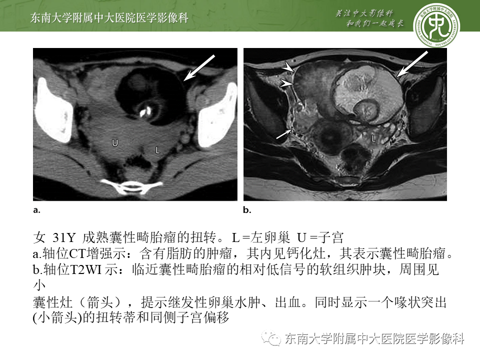 影像PPT - 【PPT】常见妇科急腹症的超声-放射诊断-24