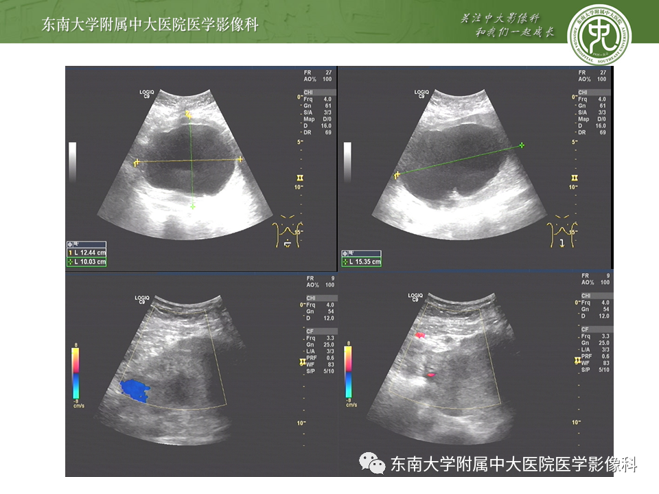 影像PPT - 【PPT】常见妇科急腹症的超声-放射诊断-25