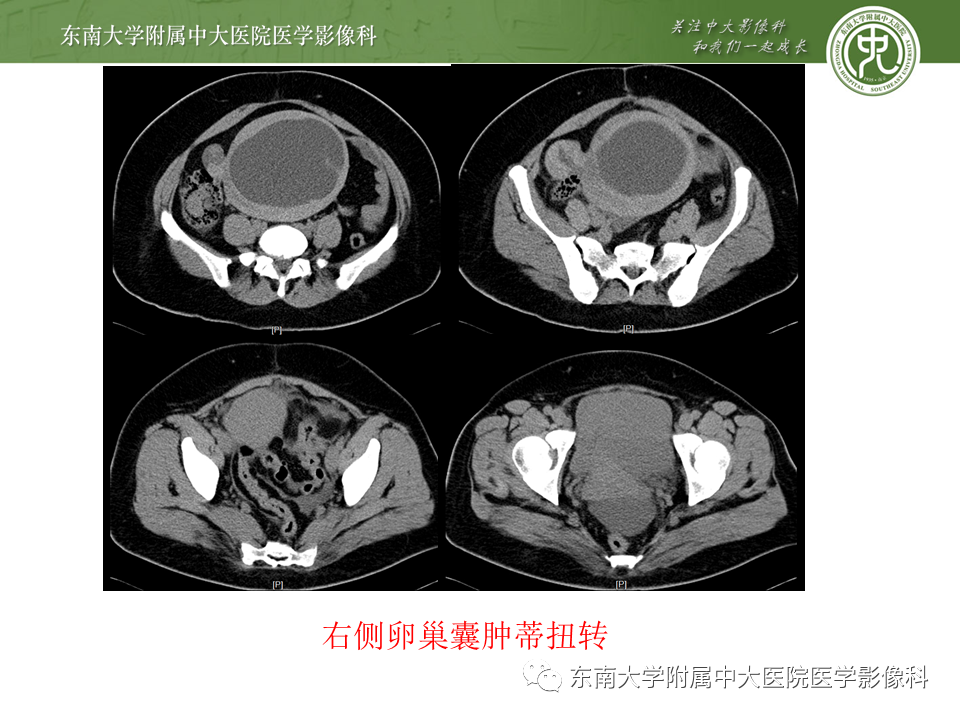 影像PPT - 【PPT】常见妇科急腹症的超声-放射诊断-26