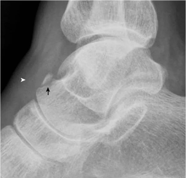 影像PPT - 足部正常的及常见病变的 X 线表现-25 影像PPT - 足部正常的及常见病变的 X 线表现-25