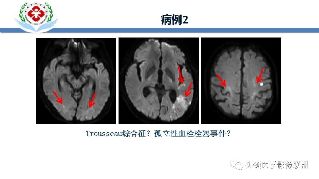 影像PPT - 【PPT】特鲁索综合征-5