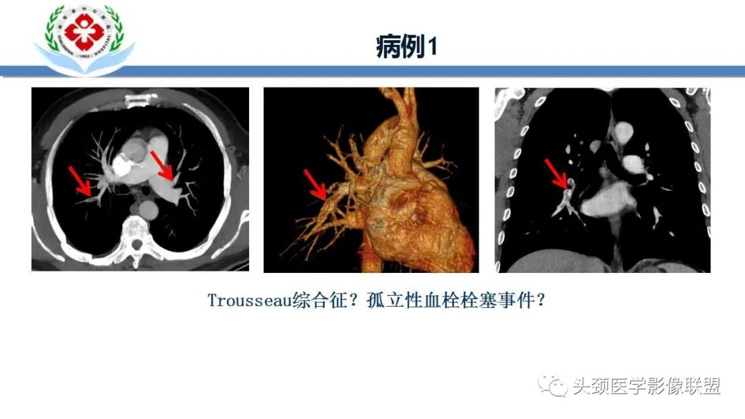 影像PPT - 【PPT】特鲁索综合征-3