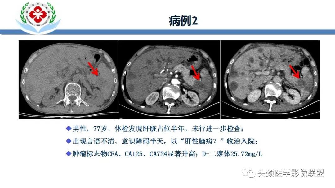 影像PPT - 【PPT】特鲁索综合征-4