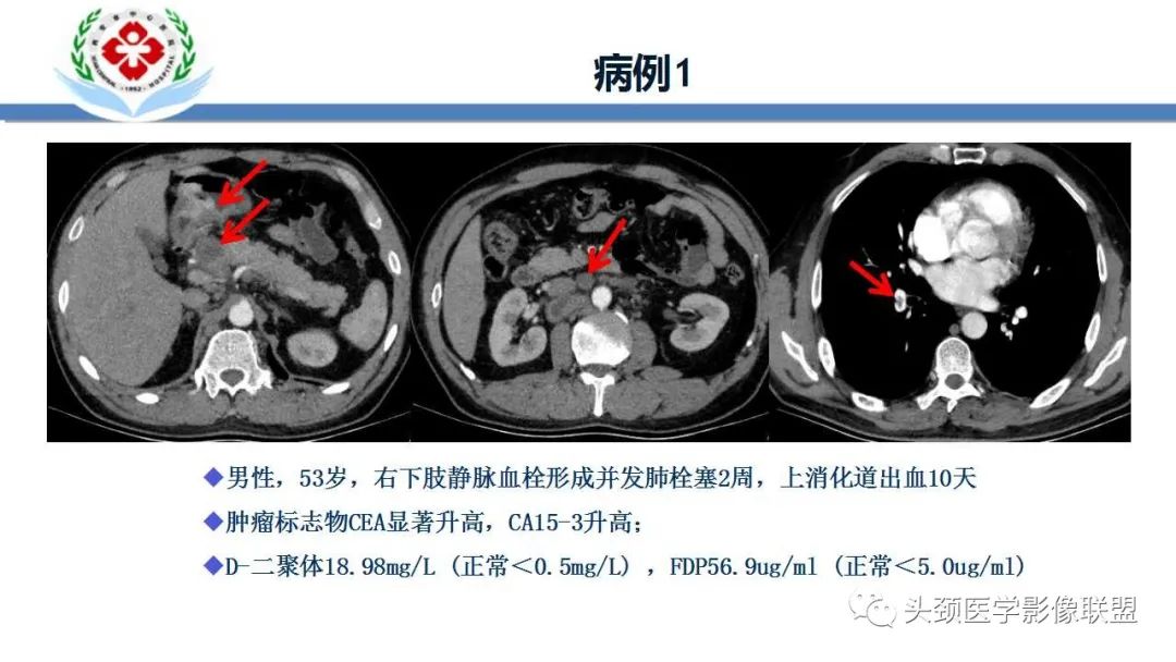 影像PPT - 【PPT】特鲁索综合征-2