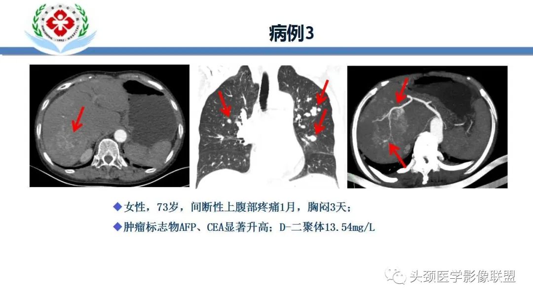 影像PPT - 【PPT】特鲁索综合征-6