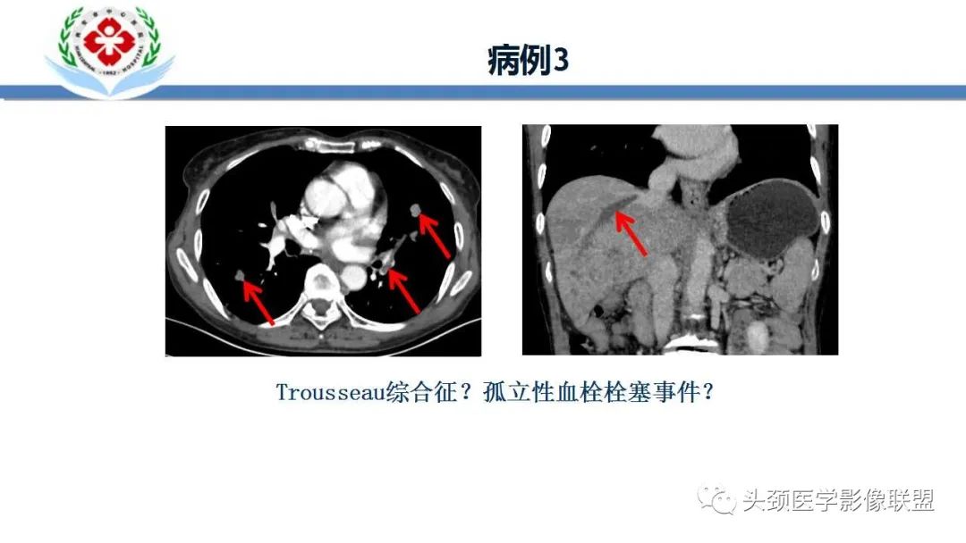 影像PPT - 【PPT】特鲁索综合征-7