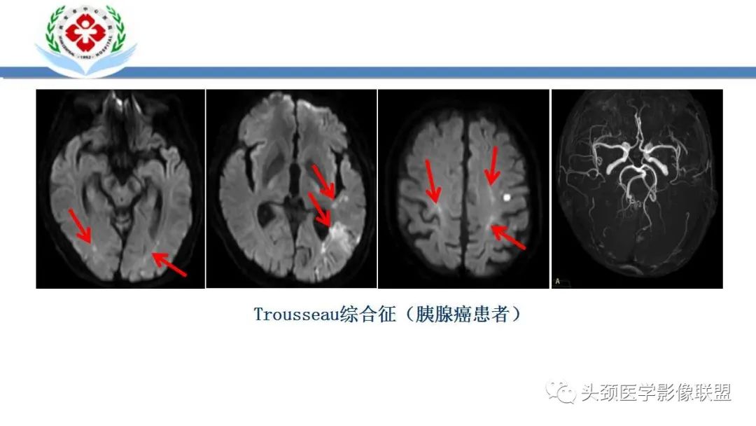影像PPT - 【PPT】特鲁索综合征-15