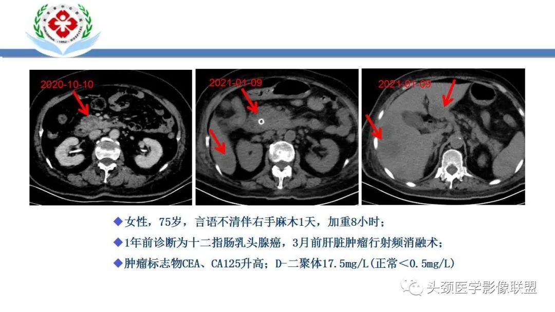 影像PPT - 【PPT】特鲁索综合征-16