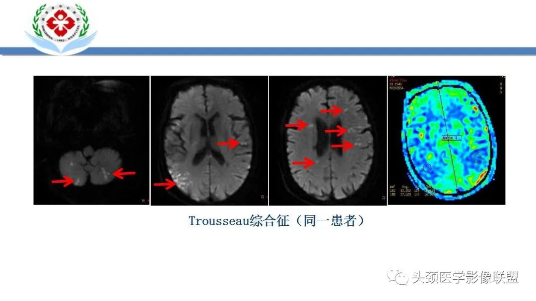 影像PPT - 【PPT】特鲁索综合征-17
