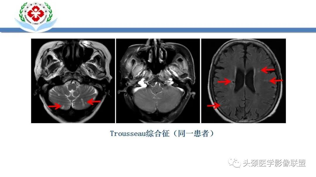 影像PPT - 【PPT】特鲁索综合征-18