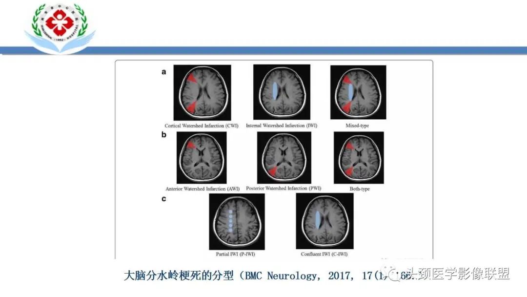影像PPT - 【PPT】特鲁索综合征-22