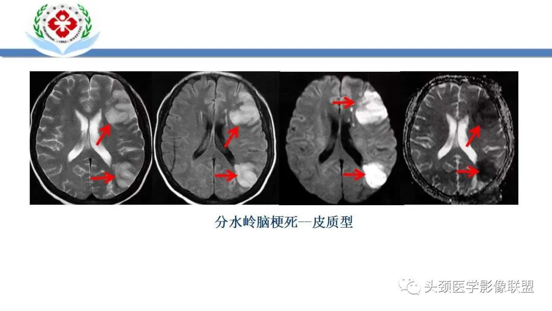 影像PPT - 【PPT】特鲁索综合征-25