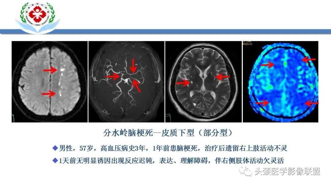 影像PPT - 【PPT】特鲁索综合征-26