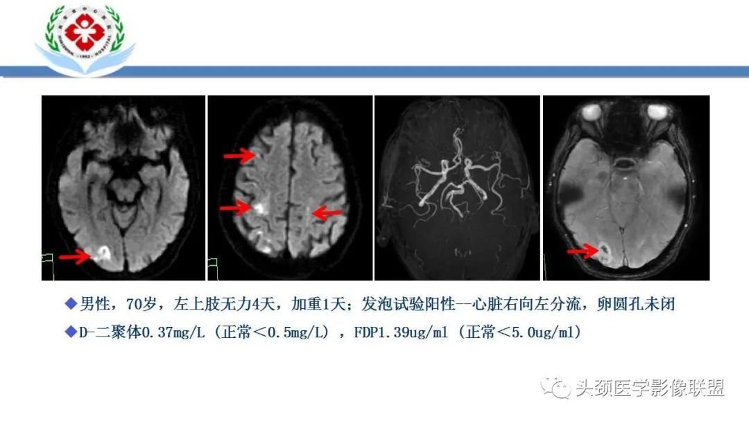 影像PPT - 【PPT】特鲁索综合征-28