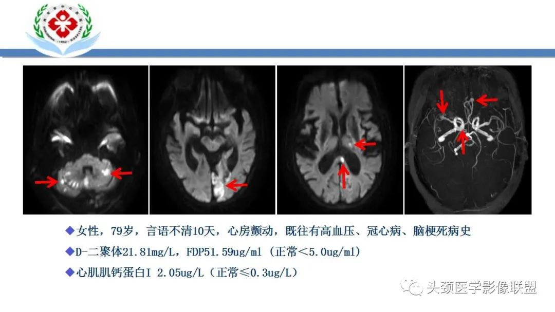 影像PPT - 【PPT】特鲁索综合征-29