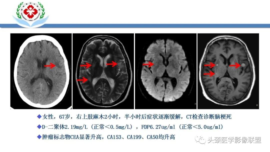 影像PPT - 【PPT】特鲁索综合征-31