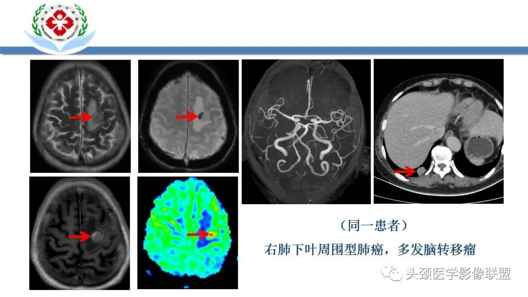 影像PPT - 【PPT】特鲁索综合征-32