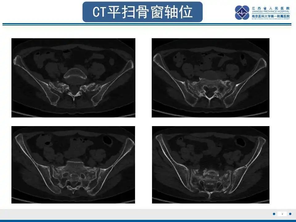 影像PPT - 【PPT】骶骨机能不全骨折-3
