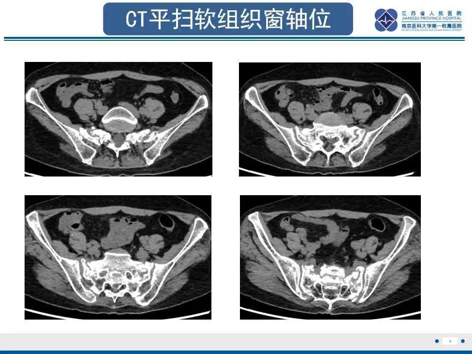 影像PPT - 【PPT】骶骨机能不全骨折-4
