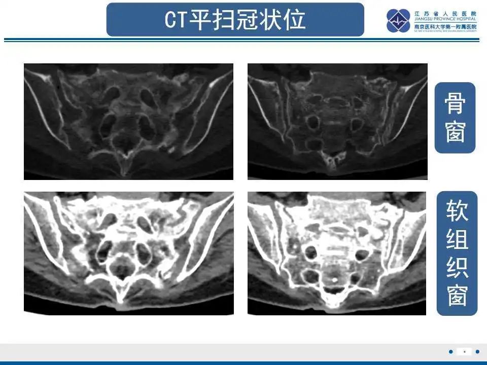 影像PPT - 【PPT】骶骨机能不全骨折-5