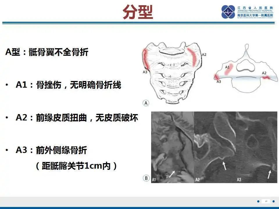 影像PPT - 【PPT】骶骨机能不全骨折-18