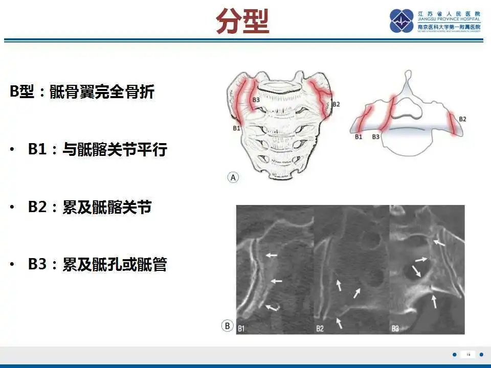 影像PPT - 【PPT】骶骨机能不全骨折-19